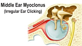 رمع الأذن الوسطى - صوت نقر غير منتظم في الأذن