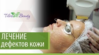 Лечение дефектов кожи. 👩 Как безопасно вылечить дефекты кожи. Telo's Beauty