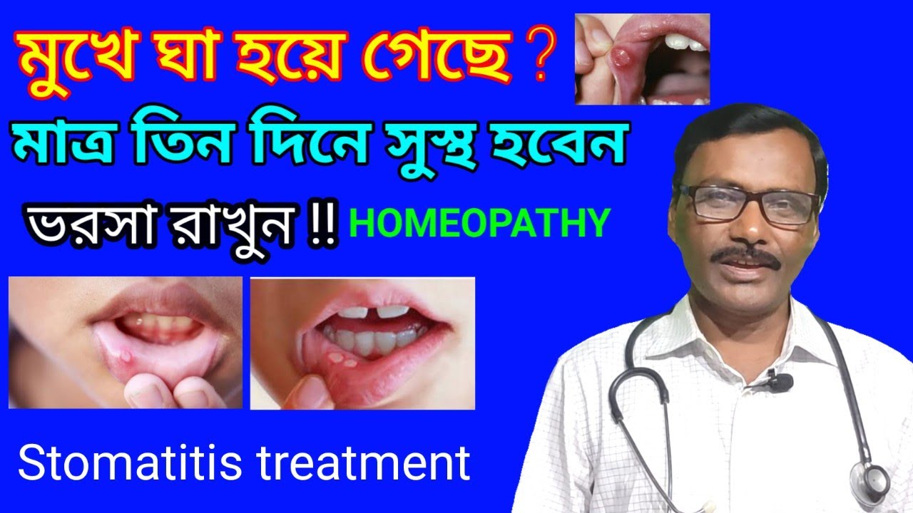 dharmanagar homoeopathic doctor || মুখে ঘা রোগের চিকিৎসা || Dr SP Goswami
