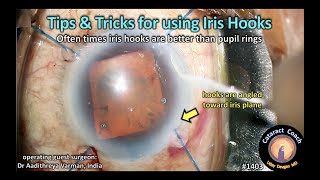 CataractCoach 1403: tips and tricks for using iris hooks