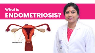 Endometriosis | What is Endometriosis? | Best Gynaecologist in Hyderabad | Dr. K. Shilpi Reddy