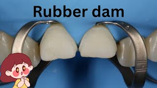 Rubber dam basics (ALL WHAT YOU NEED TO KNOW)