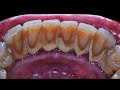 49 yo. Female&#39;s Teeth | Karang Gigi | Scaling | Satisfying | Dentist | Dokter Gigi Tri Putra