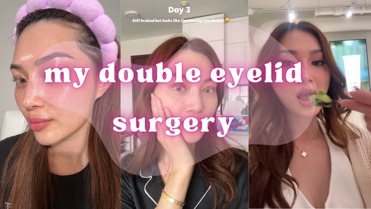 I paid $300 for my double eyelids in Vietnam!