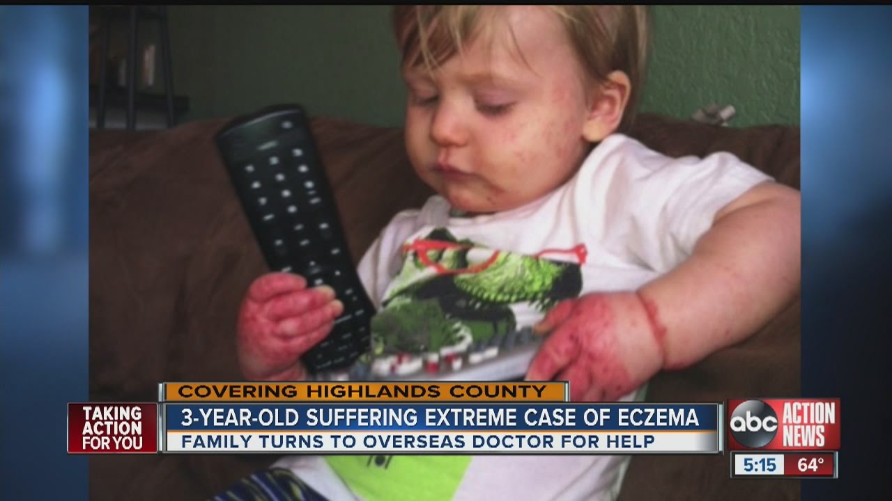 Family of 3-year-old with severe eczema hopes overseas doctor can help