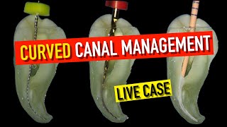 90 DEGREE CURVE ROOT CANAL | FULL PROTOCOL | 4K Resolution