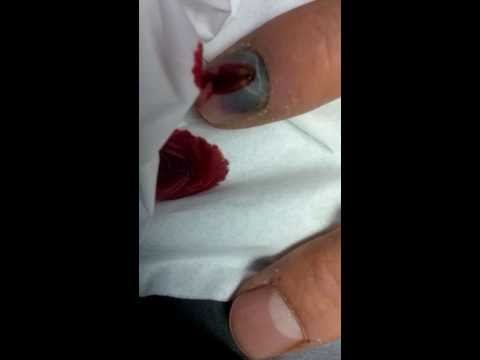 Comment soulager la pression d'un ongle écrasé gorgé de sang