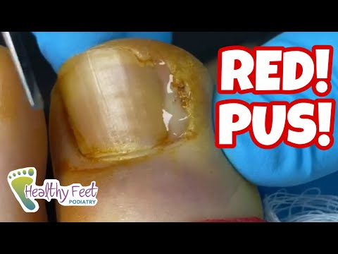 BIG RED TOE WITH PUS SEEPING OUT OF A SEVERE INFECTED INGROWN TOENAIL!