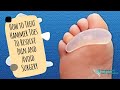 Treating Hammer Toes Without Surgery | Hammer Toe Pads