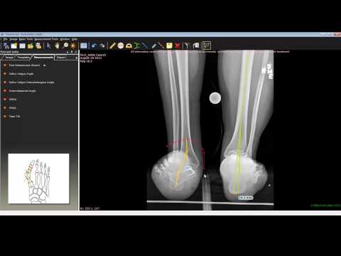 Hindfoot Deformity — video thumbnail