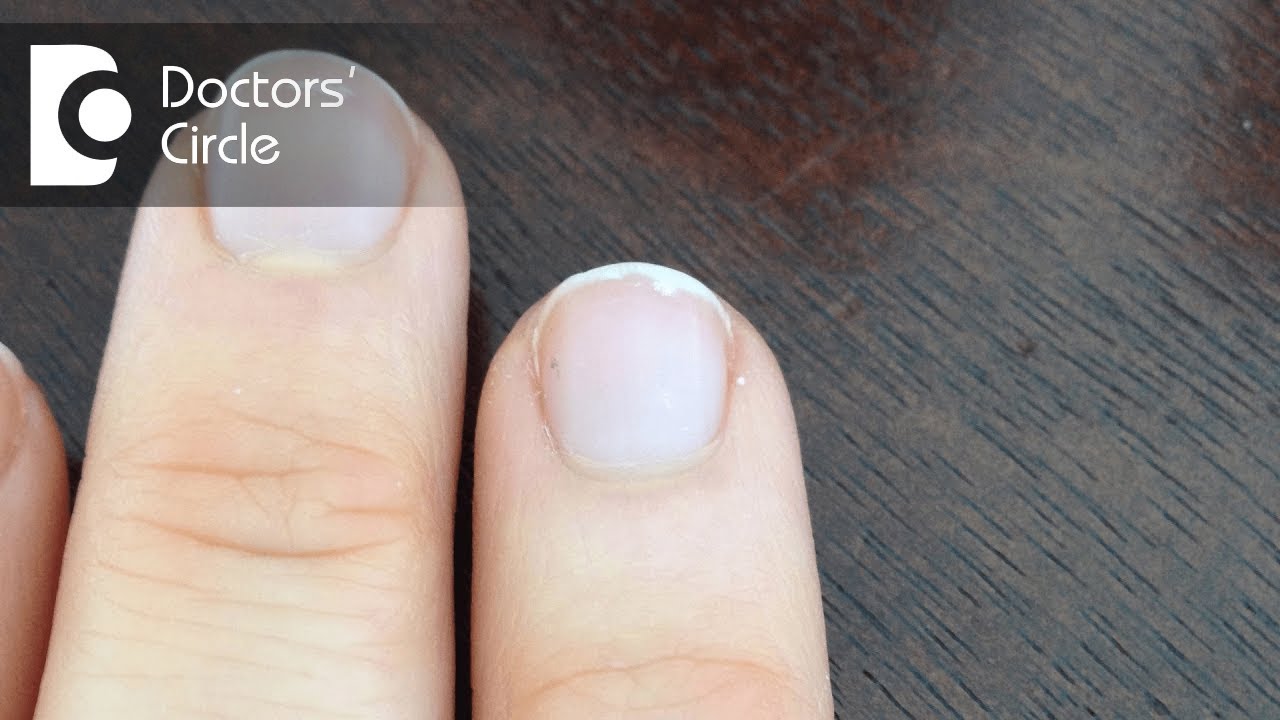 What causes sporadic raised bump on hand? - Dr. Amee Daxini