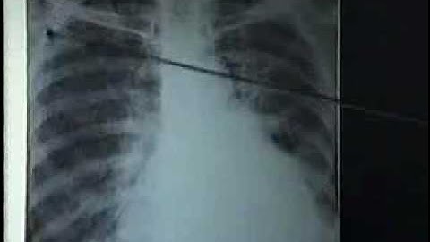 12 Ke K phoi[bacsihoasung.wordpress.com].wmv