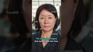 Key points for achieving the best facelift results