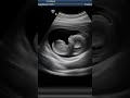 12- Weeks Ultrasound Scan | Realistic Ultrasound at 3 Months Pregnancy