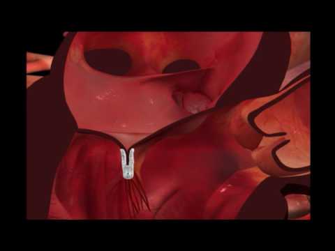 MitraClip Animation HD (narration) - MitraClip Animation HD (narration)