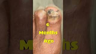 Fungal Toenails Can Be Cured #toenails #fungaltoenails #cure