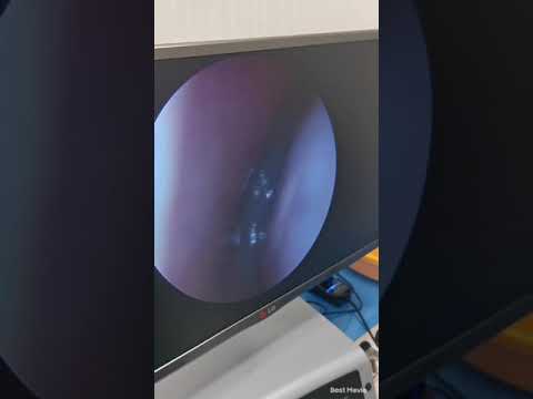 لحمية الانف بالمنظار      