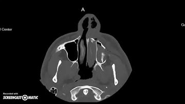 I broke my face! - Recovery time lapse
