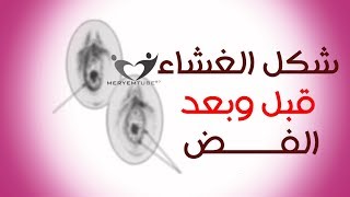 ما الفرق بين الغشاء السليم وغير السليم