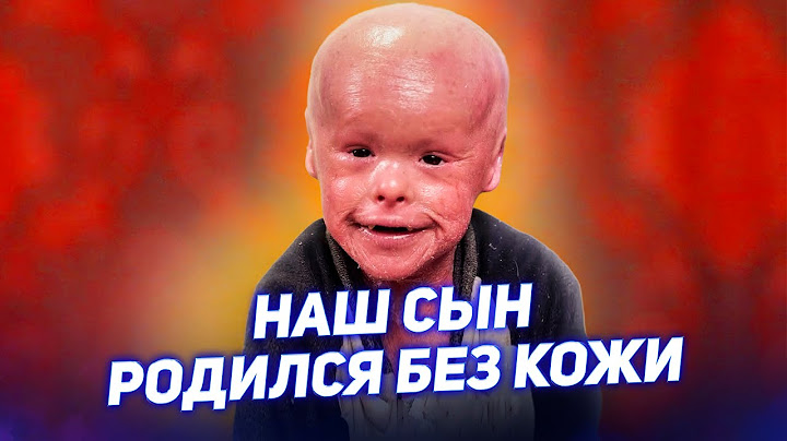 Наш сын РОДИЛСЯ БЕЗ КОЖИ / Ихтиоз АРЛЕКИНА