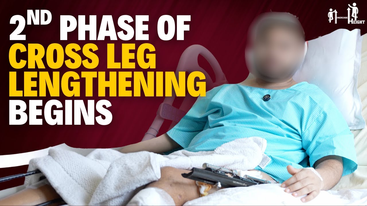 Lets Begin 2nd Phase of Cross Limb Lengthening Surgery after gaining +5.7 cm Tibia, +4.8 cm Femur