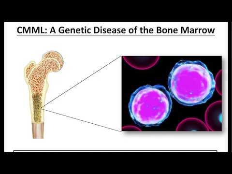 What is Chronic Myelomonocytic Leukemia?   -9/28/17