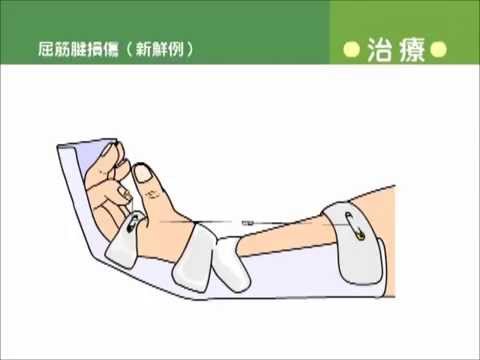 屈筋腱損傷 新鮮例 Youtube
