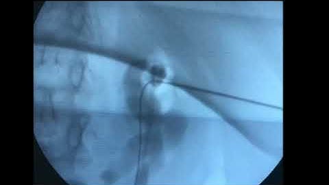 PCNL Access with Fluoroscopy   Biplanar Cephalo Caudal Technique