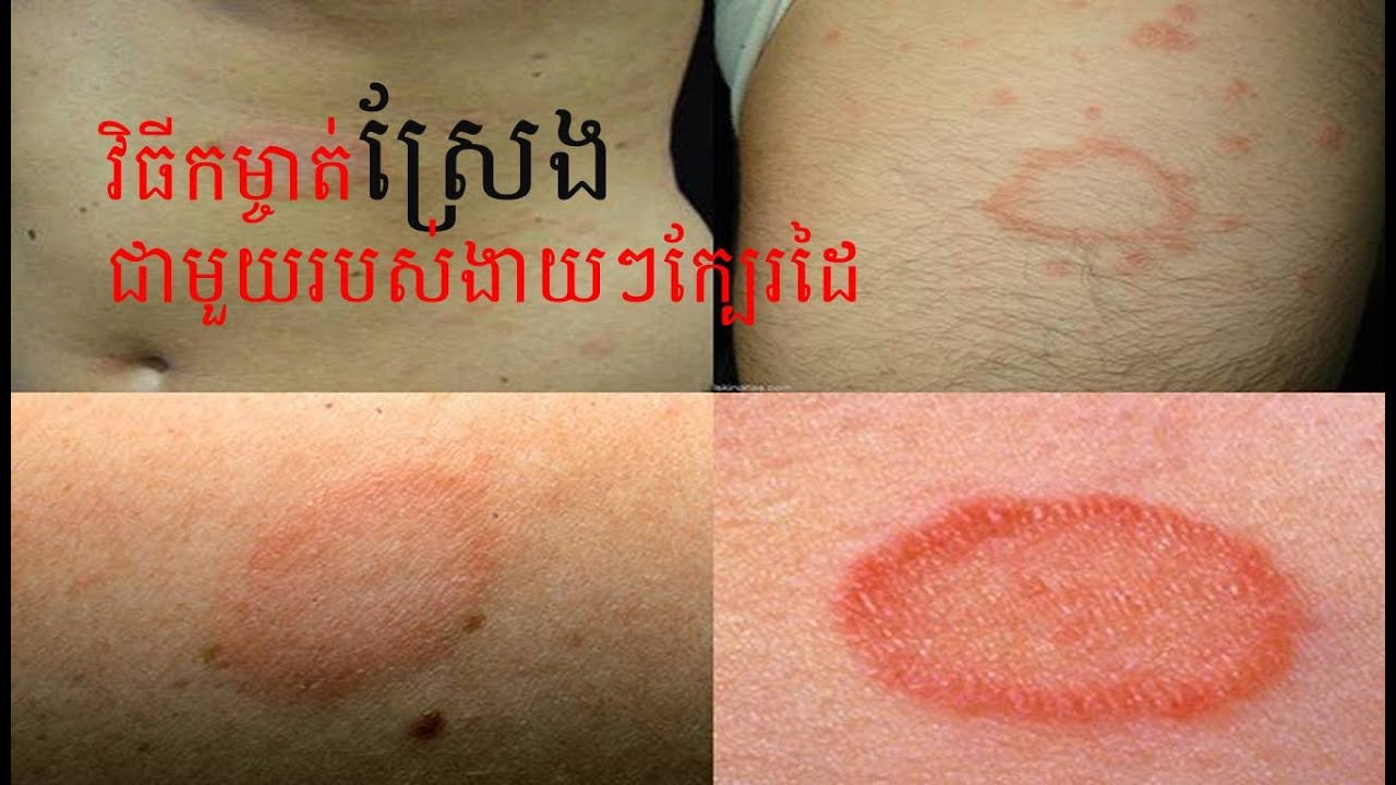 How to kill Ringwormវិធីកម្ចាត់ស្រែងតាមបែបធម្មជាតិ YouTube