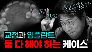 교정 먼저? 임플란트 먼저? 임플란트는 언제 심냐고요?