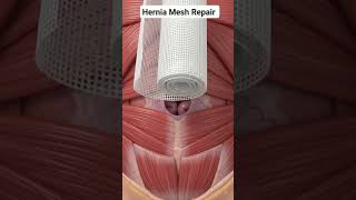 How Doctors Fix Hernia With Surgical Mesh #shorts