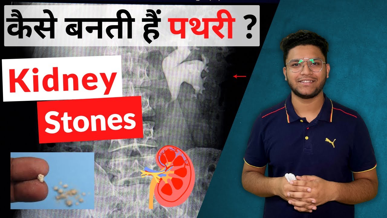 Kidney Stones Retention of Urine Renal Calculi Saad Khan YouTube