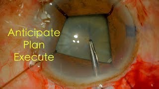 Manual SICS with Iris Retractors in an eye with Pseudoexfoliation &Loose Zonules- Dr Deepak Megur