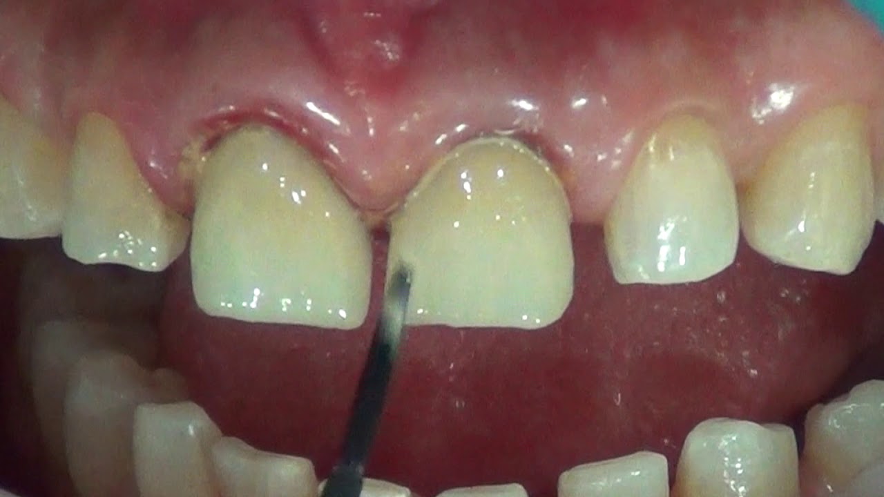Staining and glazing CEREC crowns inside the patient's mouth, one visit