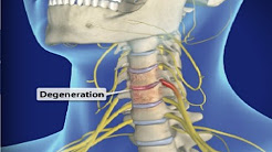 Cervical Spondylosis (Arthritis of the Neck) / Neck Pain & Pinched Nerve / Dr Mandell