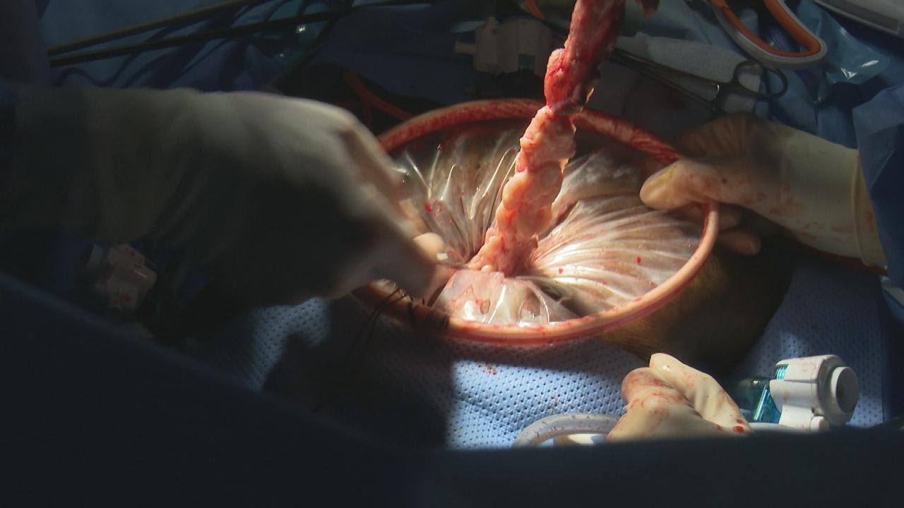 physical education Inside Woman’s Fibroid Removal Surgery