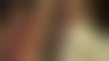 Fibula Flap Mohit Sharma