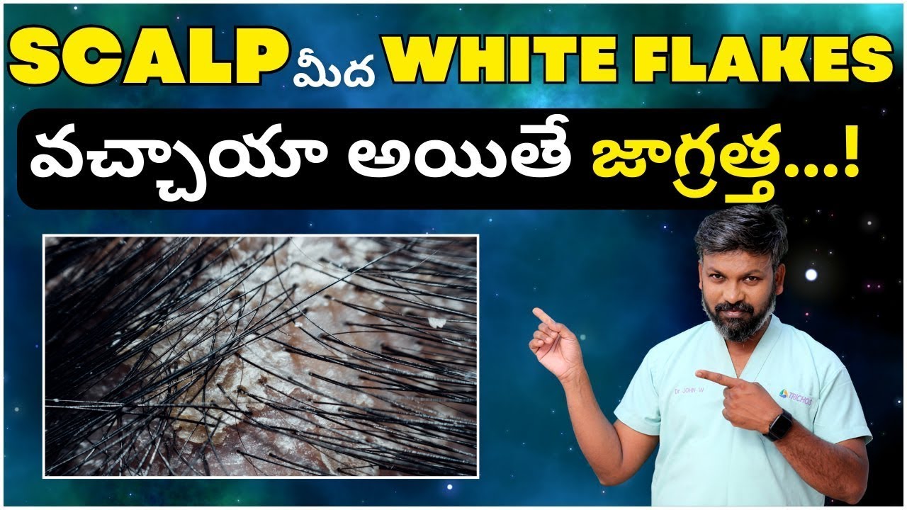 #AskDrJohnWatts | SCALP మీద WHITE FLAKES వచ్చాయా అయితే జాగ్రత్త...! | Hair Specialist Explains