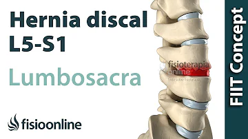 ¿Cuáles son las causas de la hernia discal L5-S1?