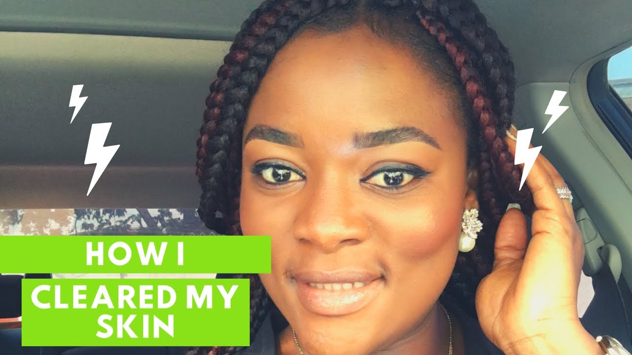 HOW I CLEARED MY SKIN - YouTube