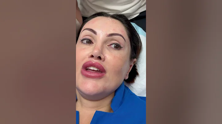 Laser removal of sebaceous hyperplasia at Newcastle Cosmetic Doctor, we are a Newcastle Australia