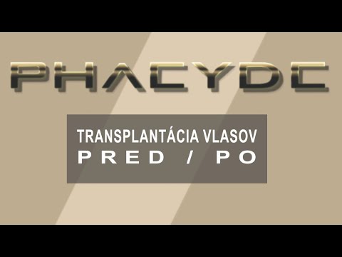 Video: Top 10 Centier Na Transplantáciu Vlasov V Dillí