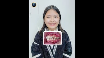 Tạm biệt răng khấp khểnh - Cham tới nụ cười tự tin rạng rỡ cùng niềng răng thẩm mỹ.