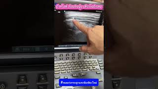 ปวดไหล่ ก้อนหินปูนอักเสบ #หมอเก่งกระดูกและข้อ #ปวดไหล่ #ไหล่ติด #เอ็นไหล่ขาด #เอ็นอักเสบ