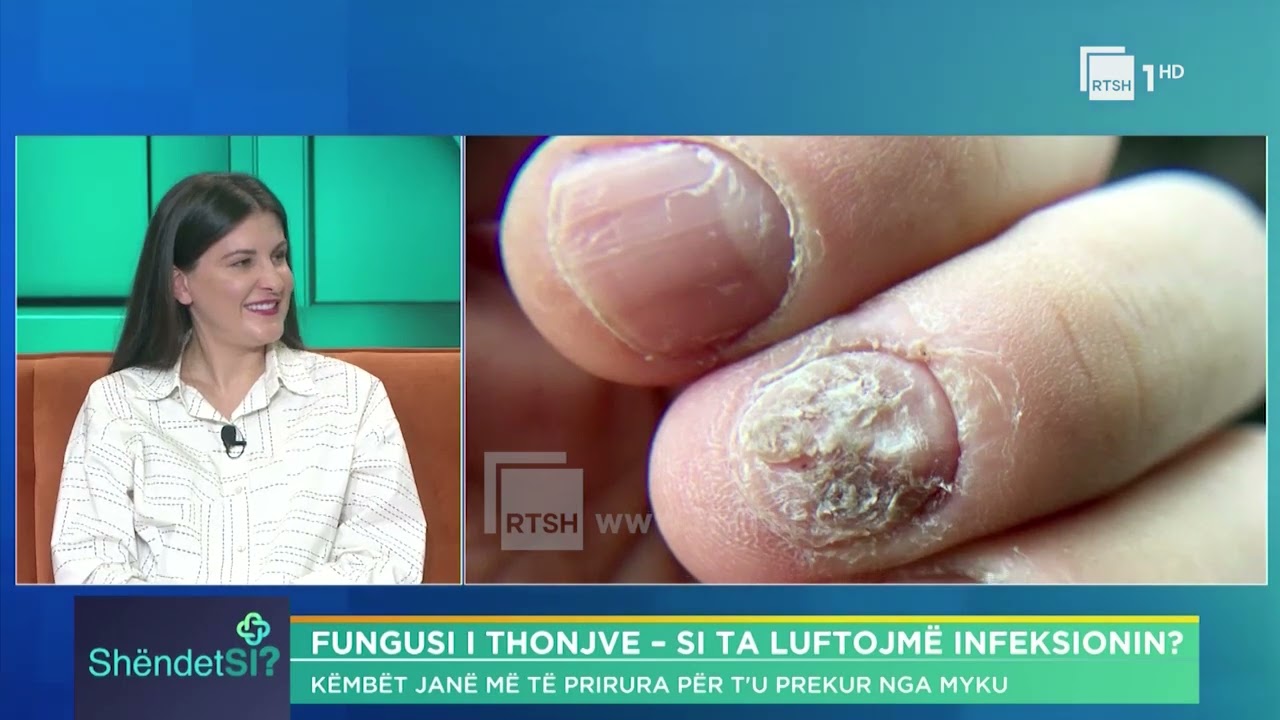Si të parandalojmë mykun e thonjve? Dr. Sidita Boriçi, dermatologe | “ShëndetSi” në RTSH