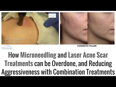 How Aggressiveness of Microneedling and Laser for Acne Scars can be Reduced by Combining Treatments