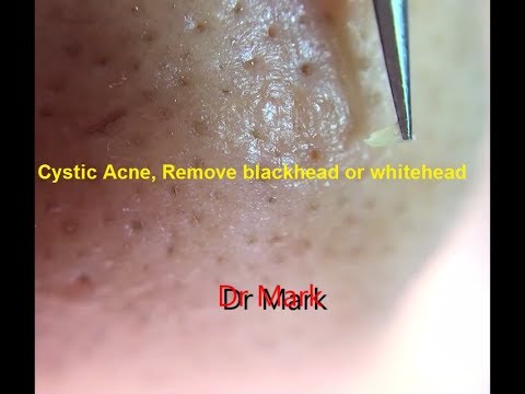 Cystic Acne, Remove blackhead or whitehead