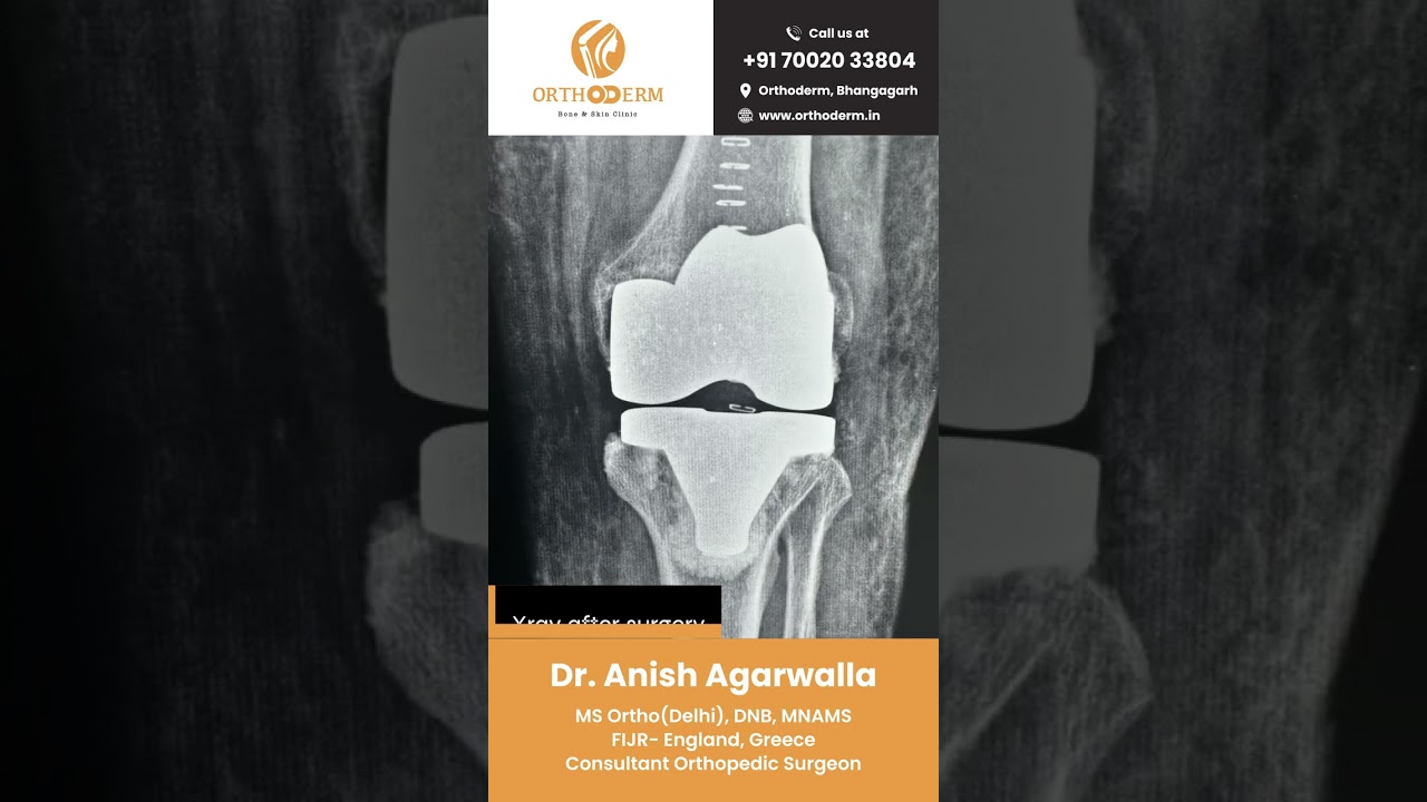 Bilateral Knee Replacement Done Together | Dr. Anish Agarwalla | Orthoderm