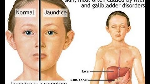 USMLE: Risk factors for unconjugated Hyperbilirubinemia by UsmleTeam