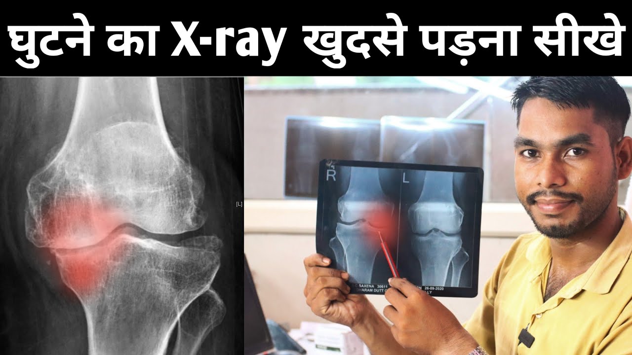 Learn To Read X ray Online Meaning Of X Ray HINDI Knee X Ray Learn To Read X ray Online Meaning Of X Ray HINDI Knee X Ray